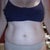 BEFORE Front view of belly.  You can't really see the damaged, pulled skin.  It's really low near my c-section scar.