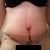 10 days post op 1 drain removed