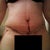 10 days post op 1 drain removed