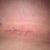 my incision at 3 weeks