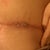 9wks & 4 days post op this is my right hip where a stitch was causing me to get alittle infection cause it wouldn't come out.....this pic look good campared to how my hip was looking