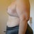 Day 13 Left breast side view