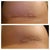 3 wk PO right and left stitches