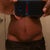 Two days shy of 7 weeks post op. I still have some uneven swelling around the incision and sides, but it's shaping up nicely. Compare post op photo around the pubic area. 
The spitting stitches are closing up as well. Once the swelling is gone I think the suture line will be tight in those areas so there shouldn't be too much of a need for a scar revision.