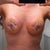 Frankenstein boobs!