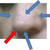 restylane was to be injected at red arrow only. Dr injected at all blue arrows
