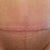 12 Weeks PO - close up of incision