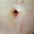Close up of navel and incision, PO day 9. The circular mark above naval is from the pain pump.