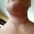 Tiny mark from chin lipo. Bruising around neck, moving down and mostly faded except my "strangulation" bruise on the left side