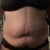 3 days pre op