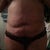 10 days post op