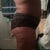 10 days post op