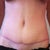 16 weeks PO, BB looks deep here. Never noticed it before just looking into the mirror. Took this after swimming so I think scar is pinker than normal due to blood flow. Might have center of scar revised at a later date. Compare freckles/mole on this pic with the yellow bra pic.