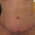 Day 18 PO. Scar is healing well. Love my belly button!!!