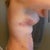 Day 1 post op.. I'll wait until the swelling goes down and the bruising improves before posting any other pictures.