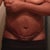 Day 8 no freakin change or hope here. Most ladies are great and going out and doing things. My body is not allowing that. I can't stand straight for a Long period