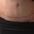 Close up of scar. Doctor says the tugs are because I'm swollen will go down once swelling gone..