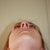 nostril underside pre-op