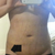 5 days Post op