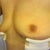 1 day post op
