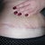 Day 40 - 5 and half wks - pulling my skin up so you can see the cut better