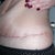 Day 40 - 5 and half wks - pulling my skin up so you can see the cut better, again dragging more skin upwards.  I'm sure it should be taut, it is on others and what I was told I would be "taut and tight"