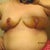 6 days post op