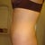 Left side - 6 months post op