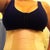 10 days post op w/garment