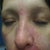 Cellulitis and staph infection in face. This is after 3 days in the hospital
