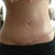 Exactly 1 month post op!