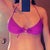 48 Hours After Pic (Same swim suit as before). The marks you see on my hips is tape from my incision.