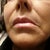 After 2d. surgery the cheeks are dropping and the lines still deep. Also my skin is dry and saggy