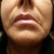 Notice my mouth is out of center when they ask me to come to see the manager she called a "doctor"(one that is not even in the page of doctor of that office) He said the mouth will be on place after a while It is been 3 month and the only change I see is my cheeks are saggier, new line and deeper lines are forming and my money is dissapearing every month paying for the high life of this crooks.
