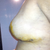 16 days post op
