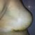 16 days post op