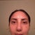 After-11 days after surgery (My nose looks very swollen but even)