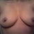 6 moths post op