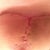 Under right breast. 21 days. Spot finally closed
