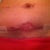 The next day after a shower. Still very swollen, the opening is pretty gross.