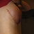 1 day post op