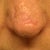 bump after restylane injection