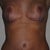 7 week post-op
