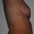 7 week post-op