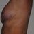 7 week post-op