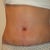 1 week post op front view - Swollen