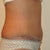 1 week post op side view - this looks like I did at about 12 weeks pregnant.