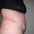 8 days PO, still very swollen