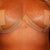7 days post op new steri strips in place