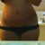 17 days post op